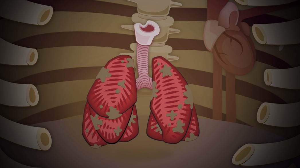 Image de poumons abimés - EPAV Média Capsule Santé physique